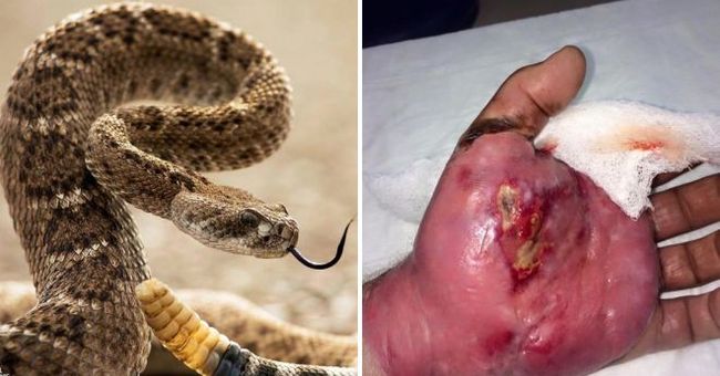 Как выглядит укус змеи на теле человека