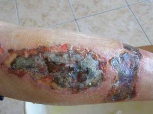 Краевая грануляция раны