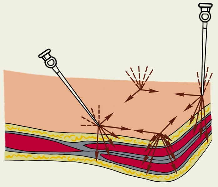 Рис. 2б). Местная инфильтрационная анестезия: по методу Брауна (стрелками и пунктиром показаны направления введения раствора новокаина)