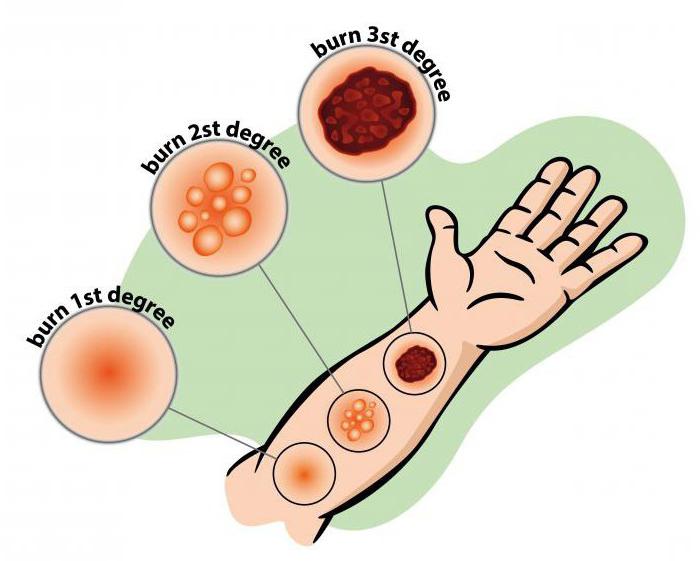 классификация ожогов