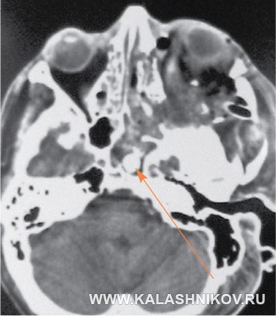 КТ травмы головы в результате выстрела из травматического пистолета. КТ последствий выстрела из травмата. Журнал Калашников