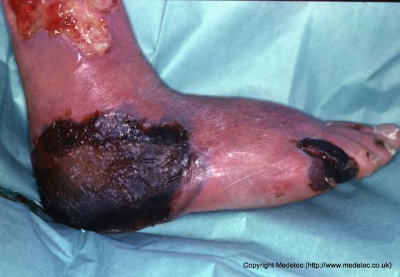 Diabetic Foot, Ischemic with Necrosis
